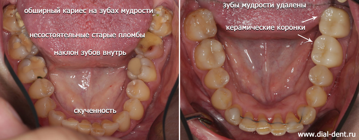 нижние зубы до и после комплексного лечения