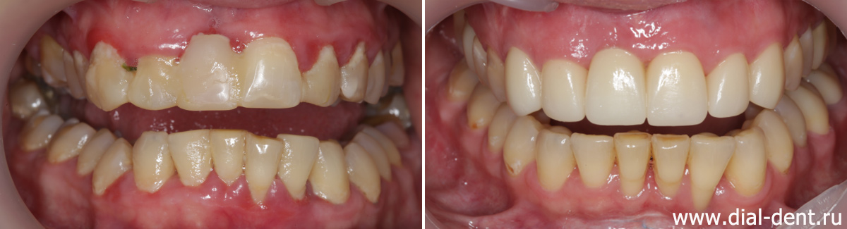 вид зубов до и после лечения и протезирования