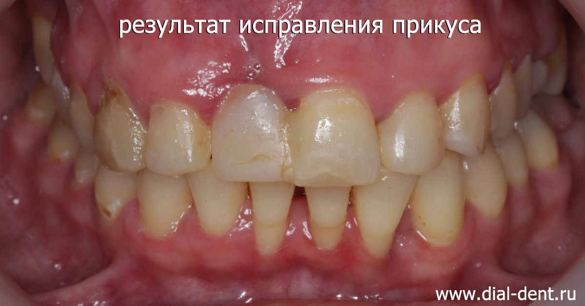 после лечения брекетами зубные ряды выровнены