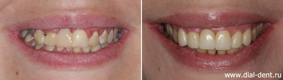 улыбка до и после лечения и протезирования