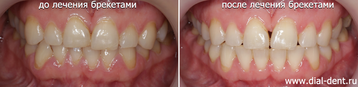 вид зубов до и после исправления прикуса брекетами