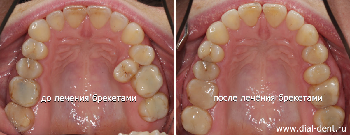 до и после ортодонтического лечения - зуб поставили в ряд