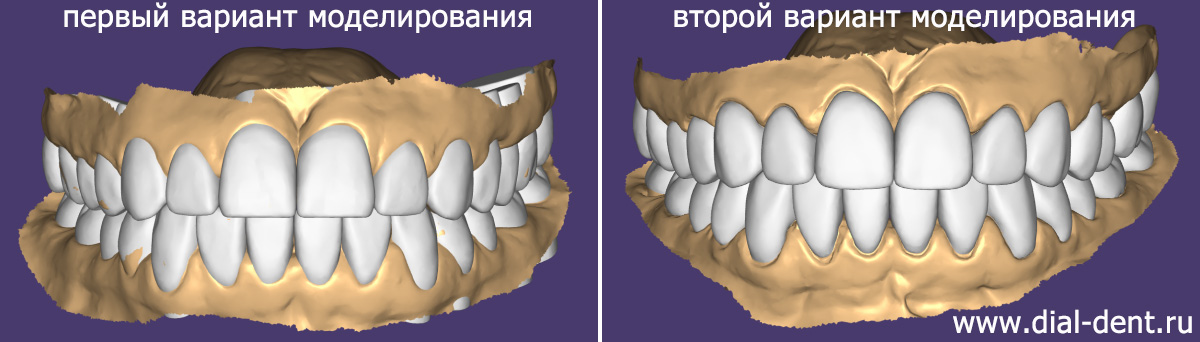 два варианта моделирования зубных коронок