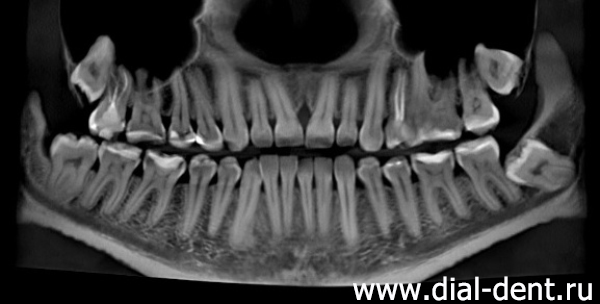 компьютерная томография зубов