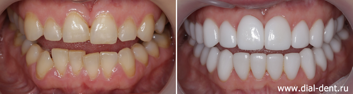 до и после тотального протезирования зубов