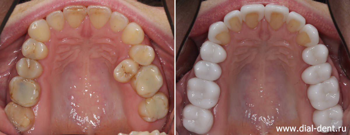 верхние зубы до и после тотального протезирования зубов керамикой