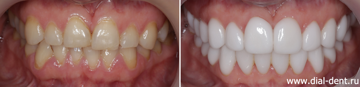до и после тотального протезирования зубов керамикой