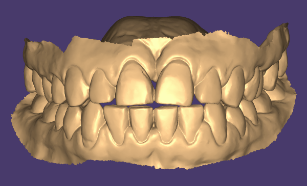 цифровой слепок зубов, полученный в результате сканирования зубов
