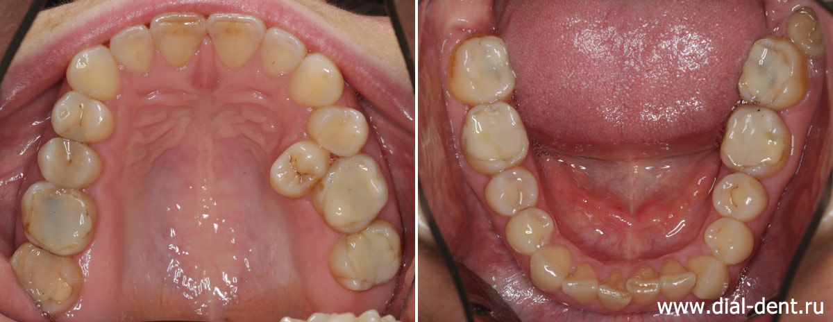 верхние и нижние зубы до лечения