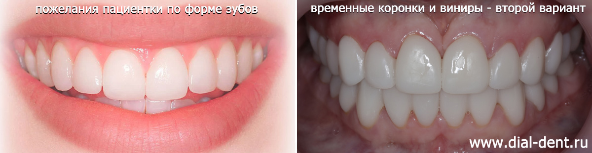 желаемая форма зубов и новый вариант временных коронок