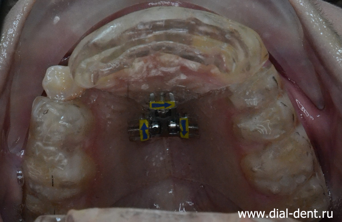 пластиночный ортодонтический аппарат 