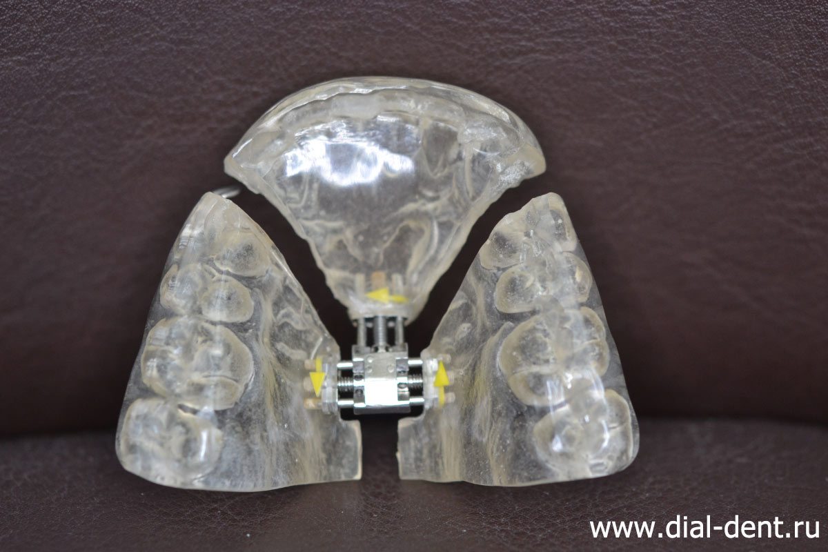пластиночный ортодонтический аппарат 