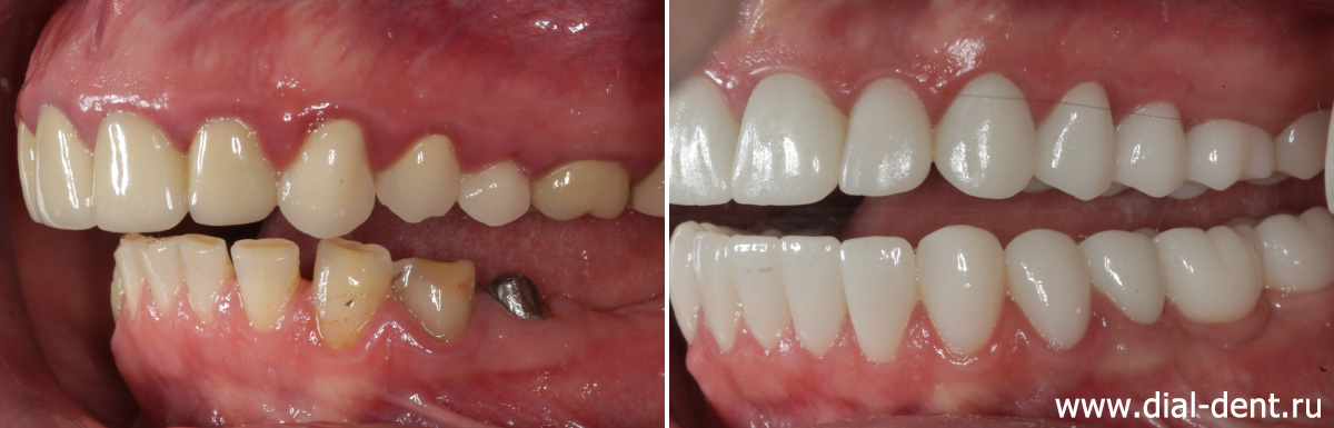 вид слева до и после протезирования зубов с комплексной подготовкой