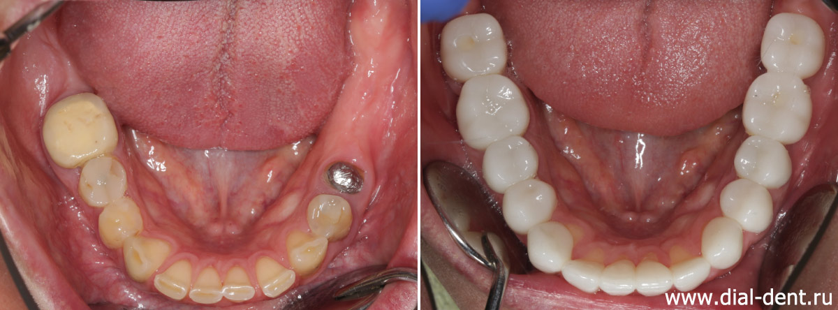 нижние зубы до и после протезирования зубов с комплексной подготовкой