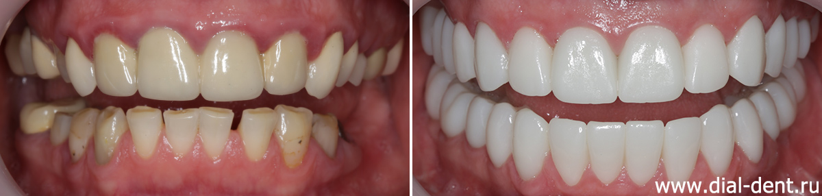 до и после протезирования зубов с комплексной подготовкой