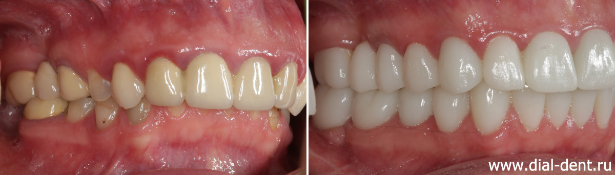 вид справа до и после протезирования зубов с комплексной подготовкой
