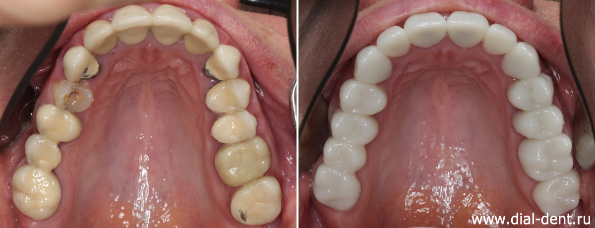 верхние зубы до и после протезирования зубов с комплексной подготовкой