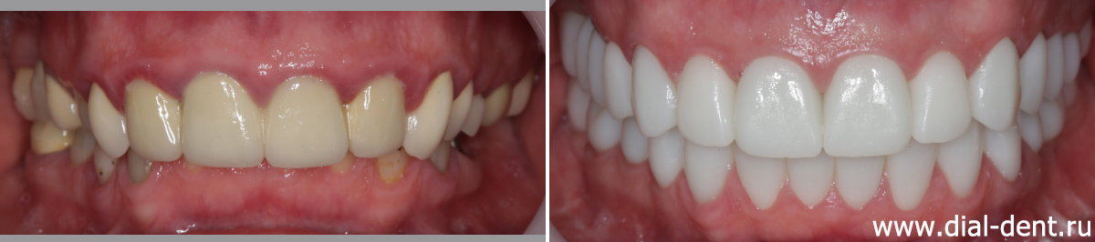 комплексное лечение и полное протезирование зубов керамикой - до и после