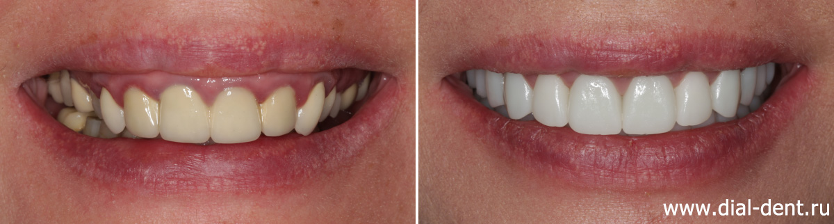 улыбка до и после протезирования зубов с комплексной подготовкой