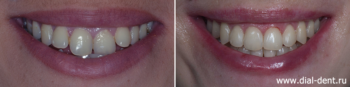 улыбка до и после комплексного лечения в Диал-Дент