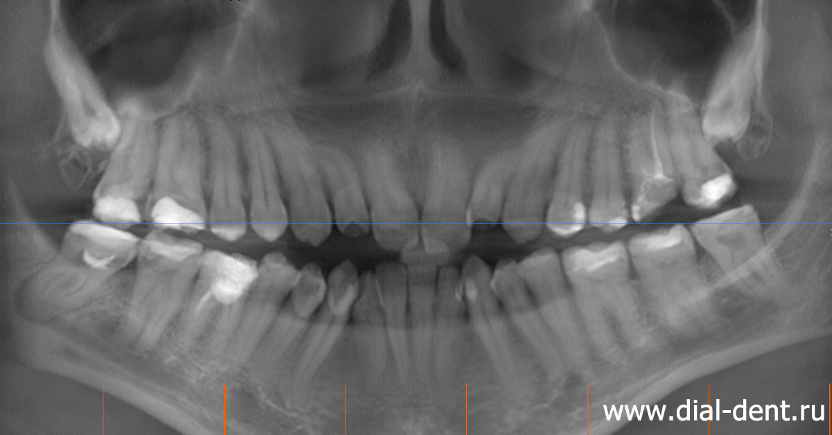 фрагмент компьютерной томограммы зубов до лечения