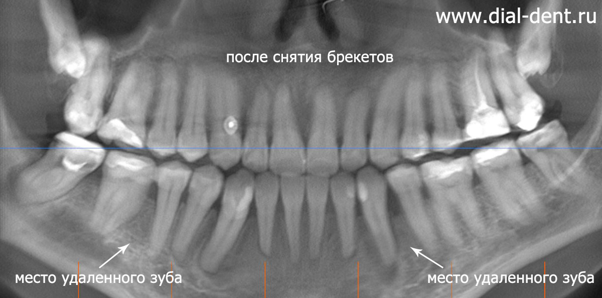 снимок зубов после ортодонтического лечения