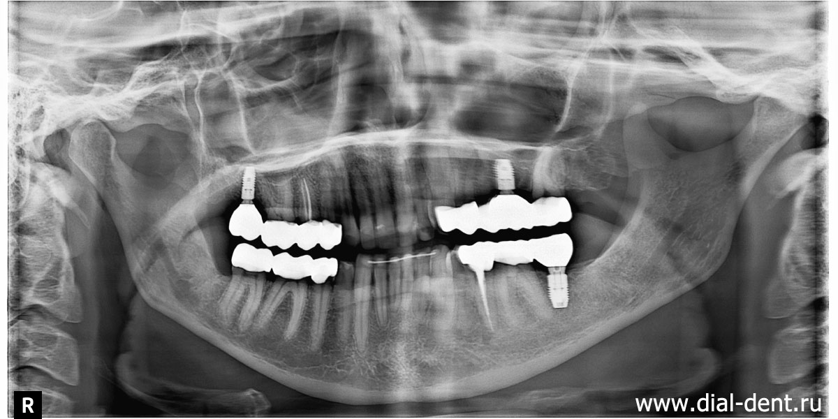 фрагмент КТ-зубов после имплантации и протезирования зубов