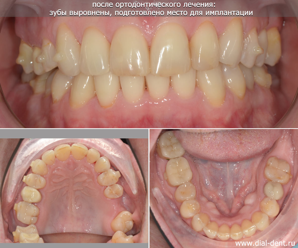 итоги ортодонтического лечения - зубы ровные, подготовлено место для имплантов