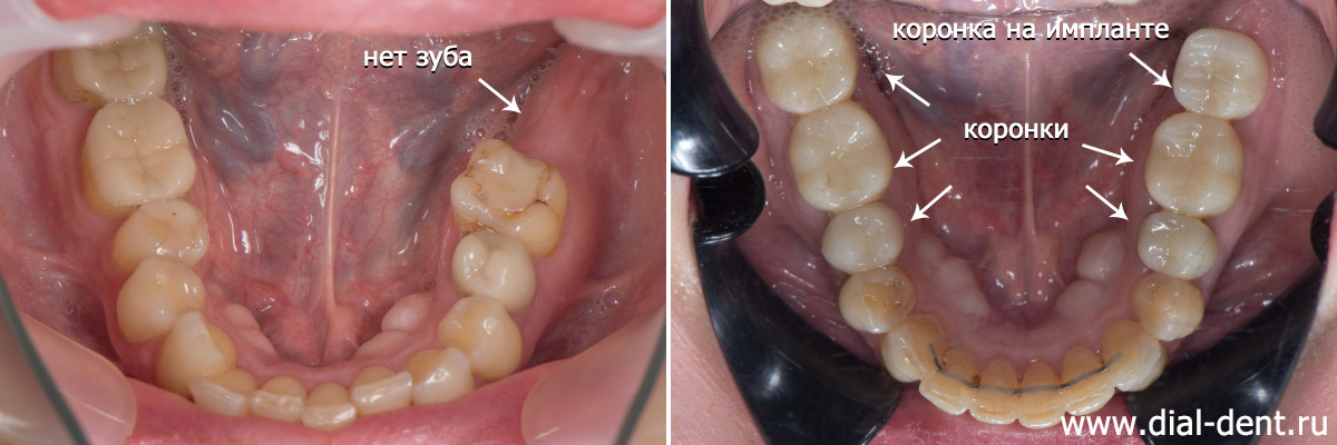 нижние зубы до и после комплексного лечения с протезированием