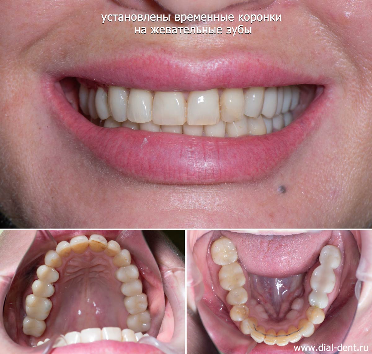 временные коронки на жевательных зубах и имплантах