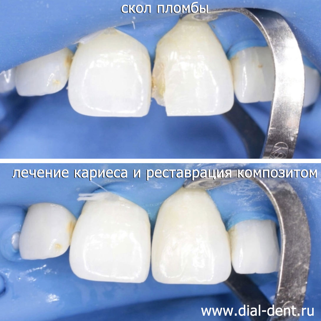ремонт скола пломбы на переднем зубе