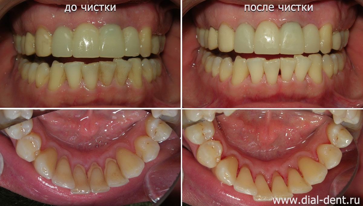 до и после профессиональной чистки зубов
