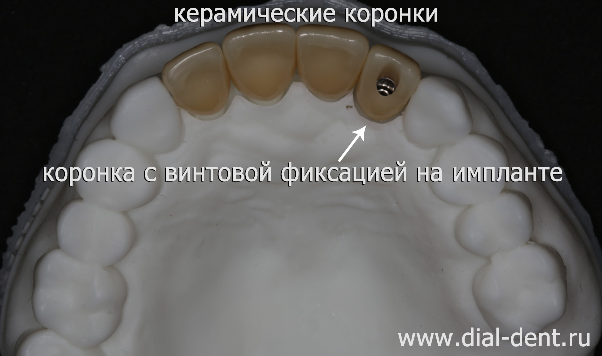 керамические коронки передних зубов на модели