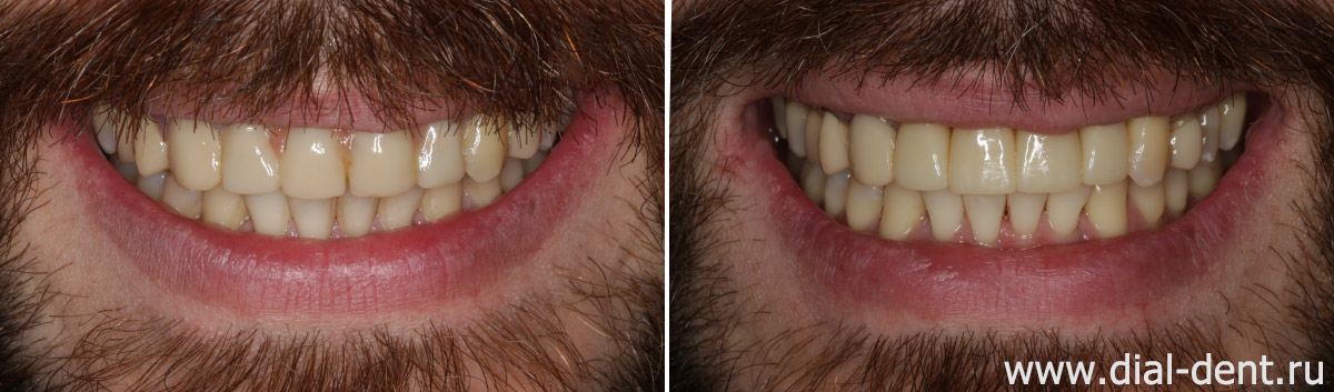 улыбка до и после имплантации и протезирования