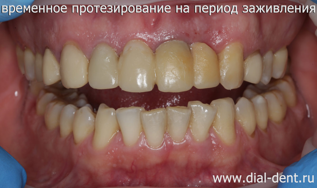 временное протезирование композитом в день удаления зуба