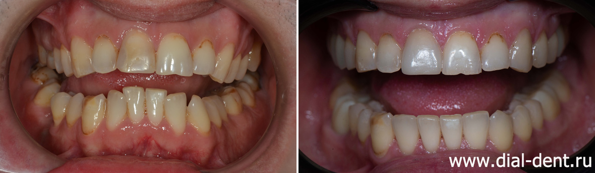 до и после лечения, имплантации и протезирования зубов