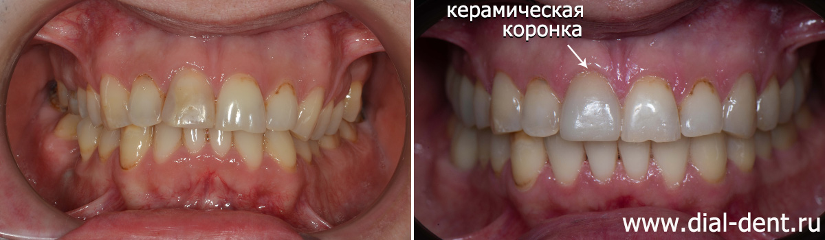 до и после лечения, имплантации и протезирования зубов