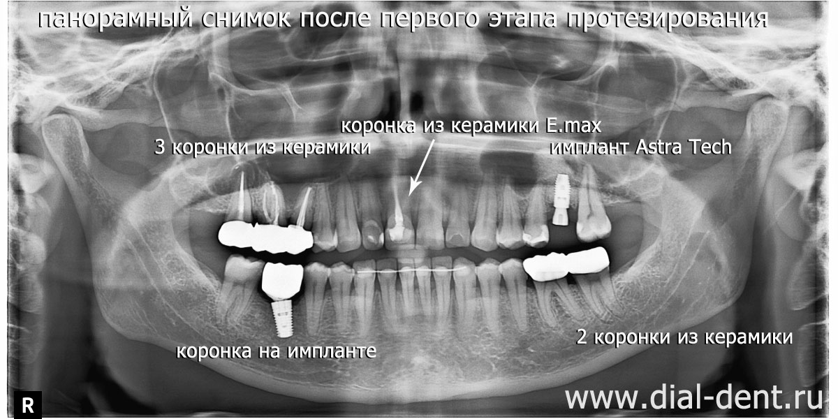 первый этап протезирования зубов