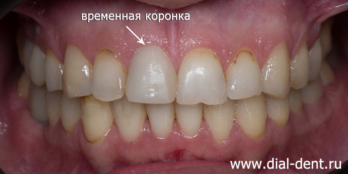 временная коронка на переднем зубе