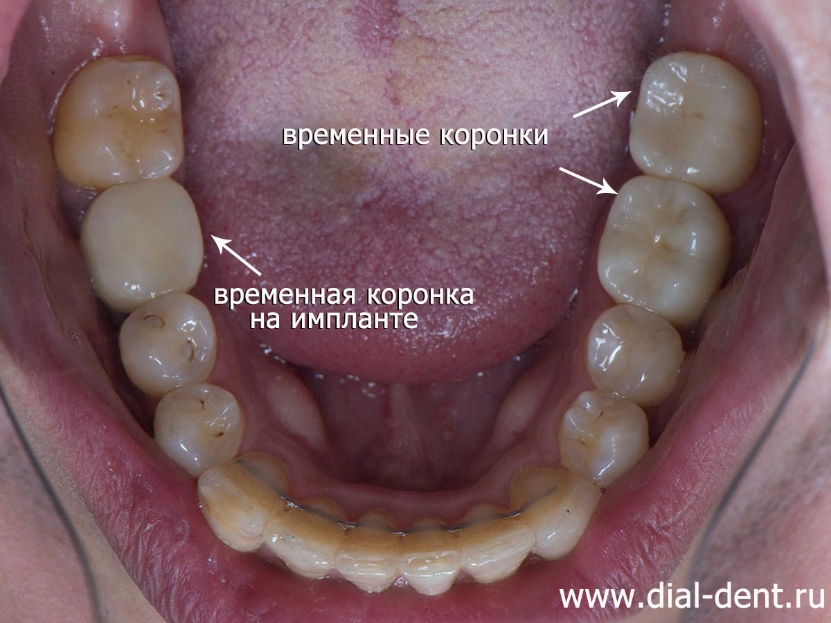 этап протезирования зубов