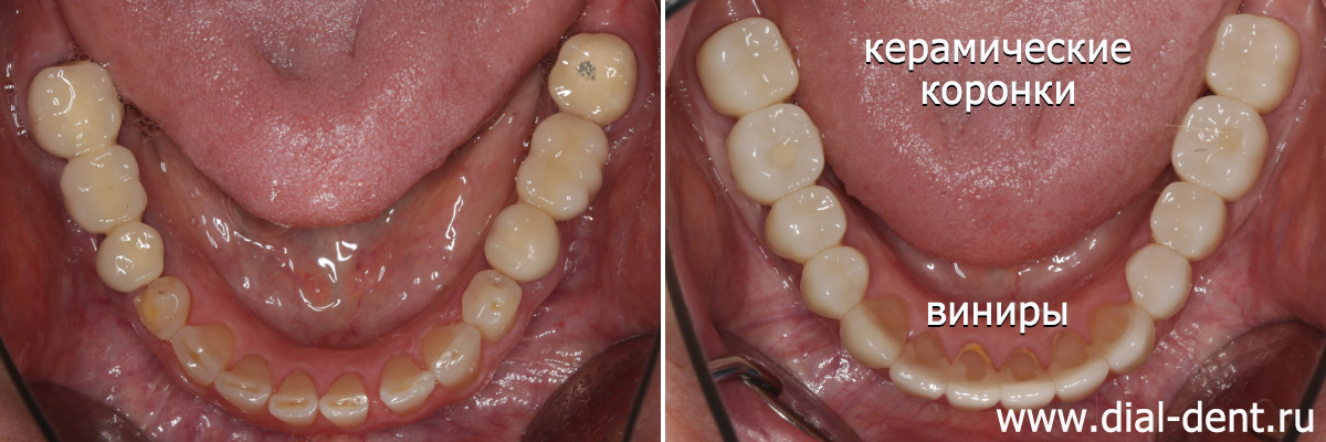 нижние зубы до и после протезирования керамикой