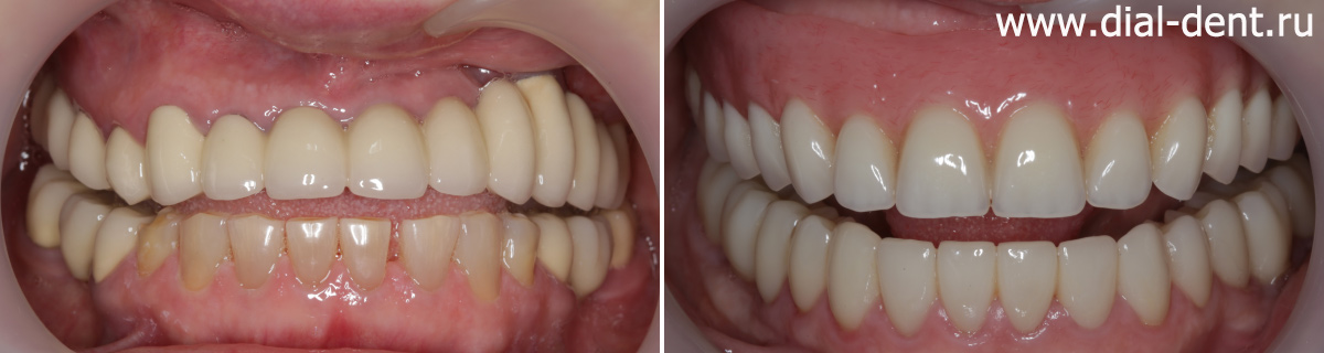 до и после сложного протезирования зубов