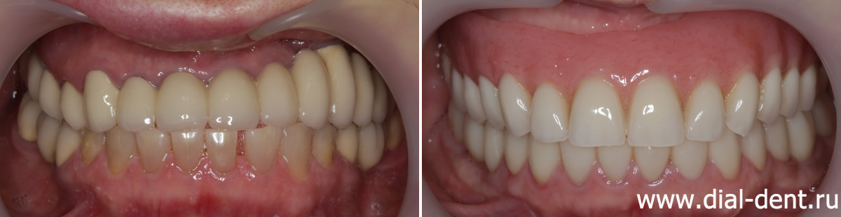 вид до и после протезирования зубов