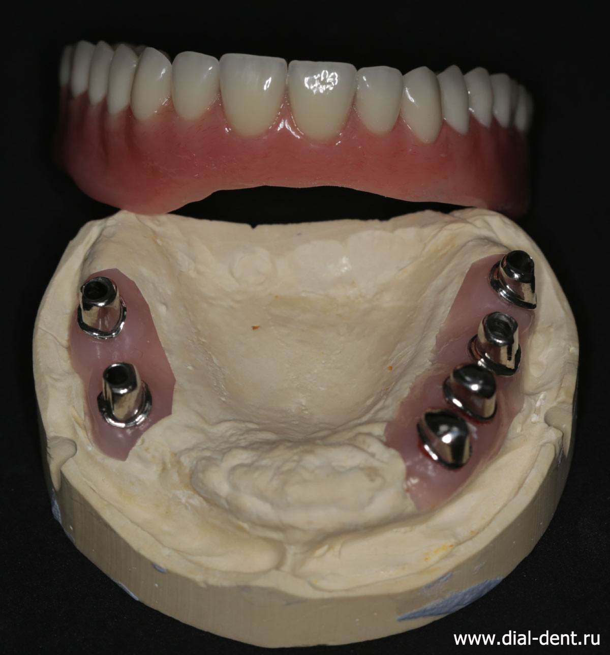 модель верхней челюсти и съемный телескопический протез верхних зубов