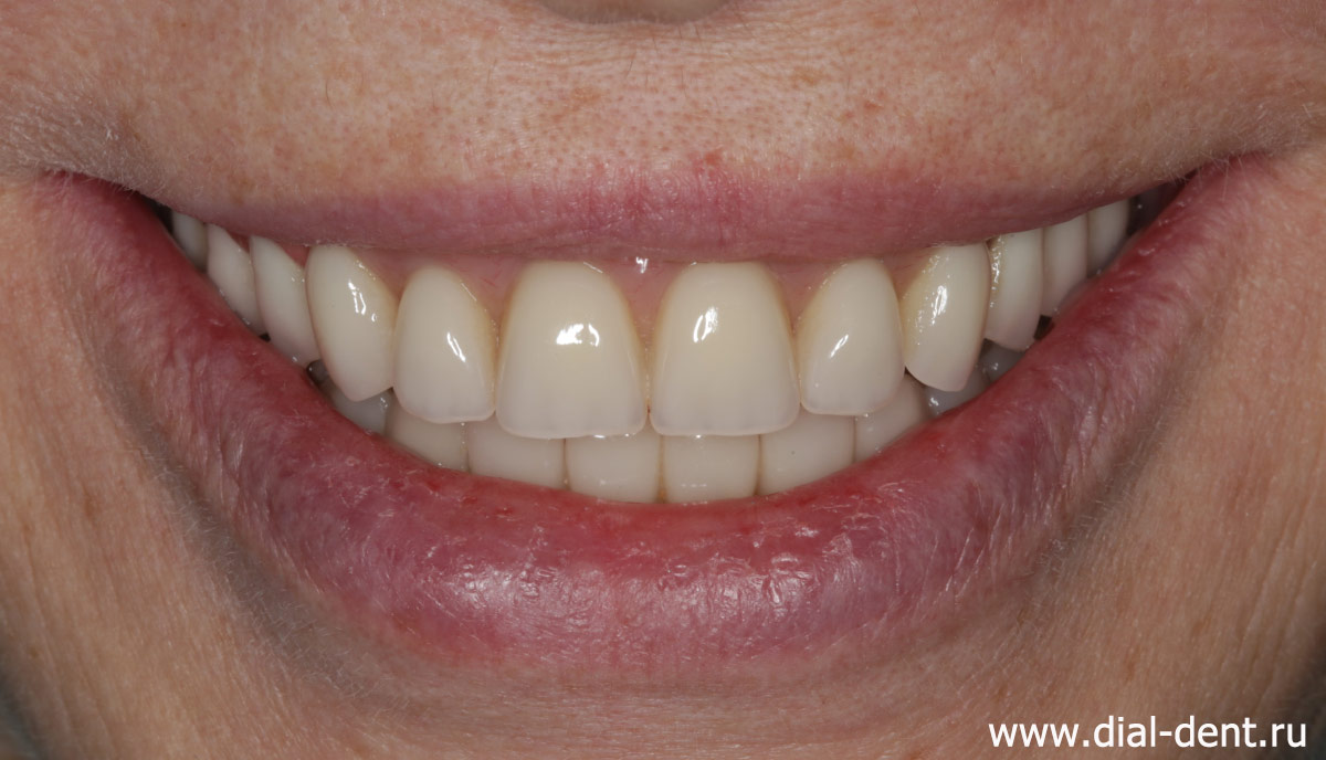 улыбка после протезирования зубов в Диал-Дент