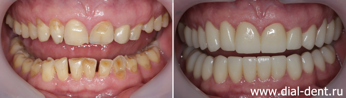 до и после протезирования зубов керамикой