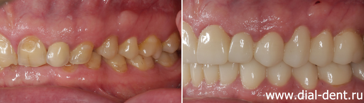 вид слева до и после протезирования зубов керамикой