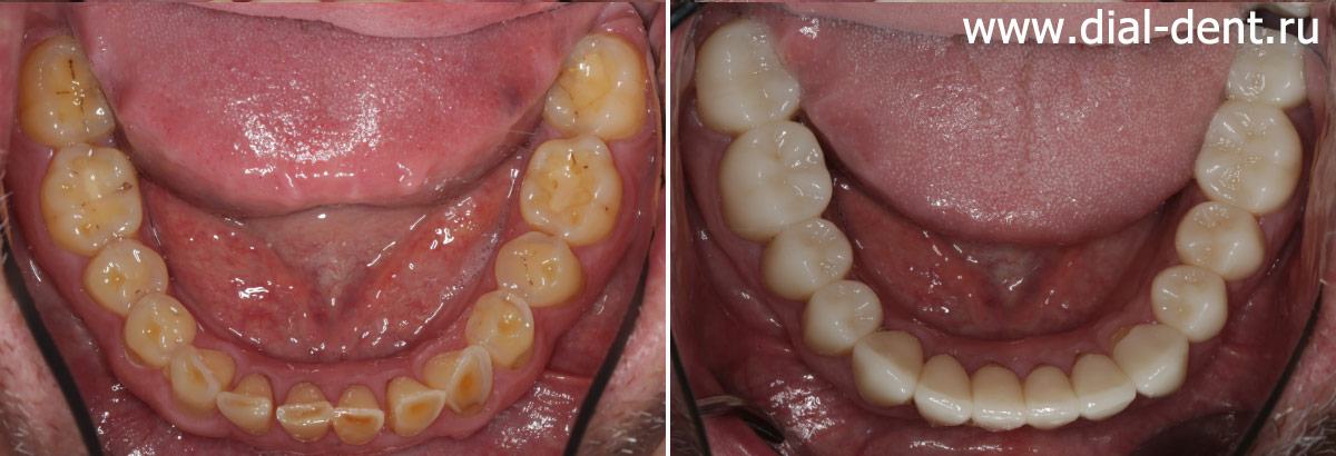 нижние зубы до и после протезирования керамическими коронками