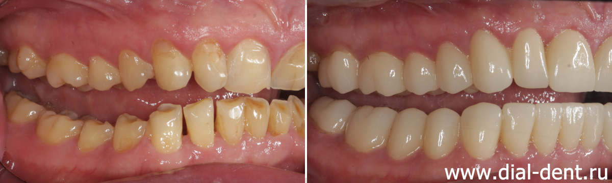 вид справа до и после протезирования зубов керамикой