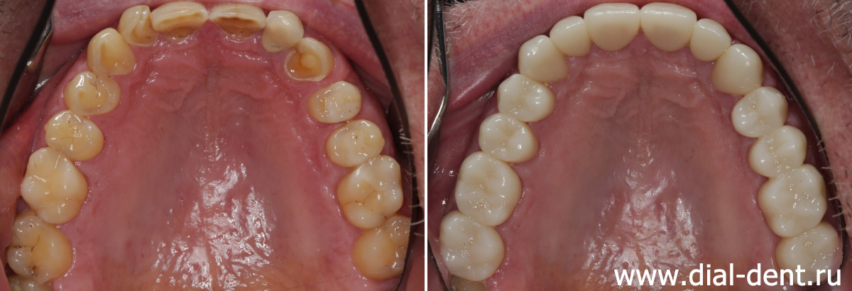 верхние зубы до и после протезирования керамическими коронками